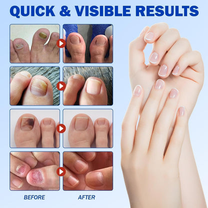 Fungal Nail Patch Treatment